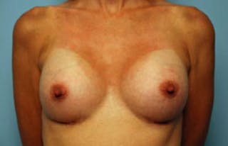 Breast Augmentation Before & After Gallery - Patient 327819 - Image 2