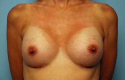 Breast Augmentation Before & After Gallery - Patient 379535 - Image 2