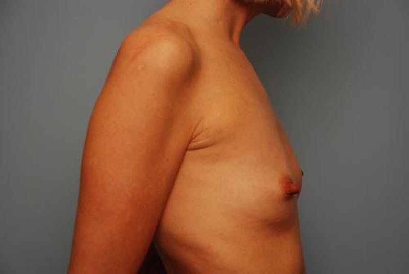 Breast Augmentation Before & After Gallery - Patient 327819 - Image 5