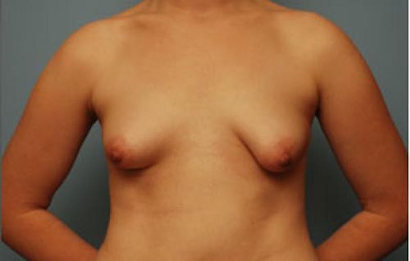 Breast Augmentation Before & After Gallery - Patient 413316 - Image 1