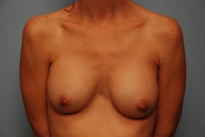 Breast Augmentation Before & After Gallery - Patient 282898 - Image 2