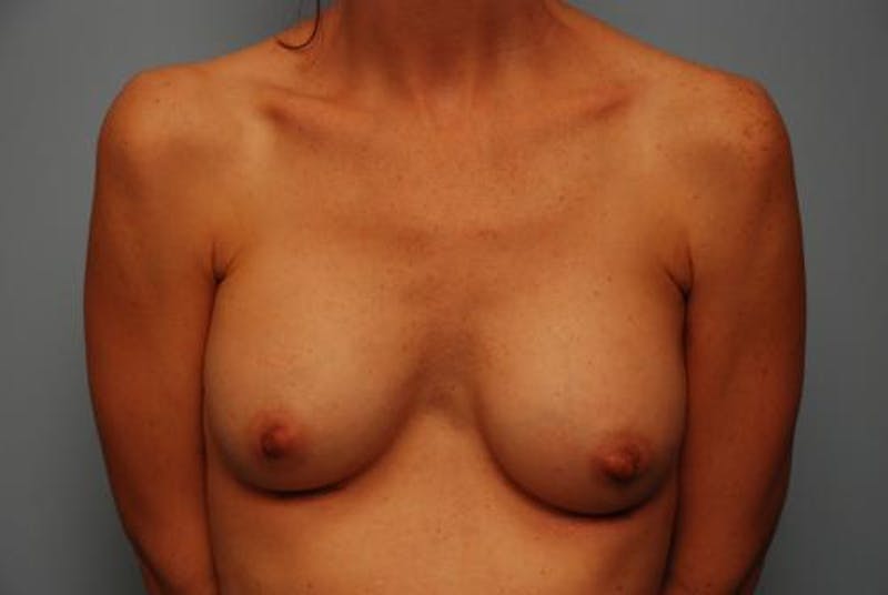 Breast Augmentation Before & After Gallery - Patient 226519 - Image 2