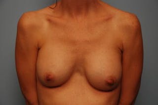 Breast Augmentation Before & After Gallery - Patient 226519 - Image 2