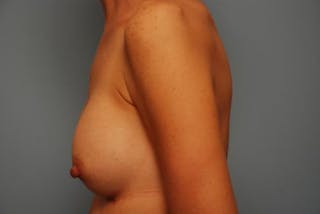 Breast Augmentation Before & After Gallery - Patient 226519 - Image 10