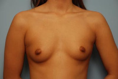 Breast Augmentation Before & After Gallery - Patient 450915 - Image 1