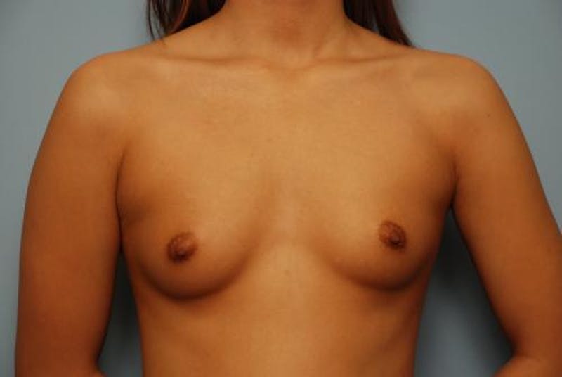 Breast Augmentation Before & After Gallery - Patient 186890 - Image 1