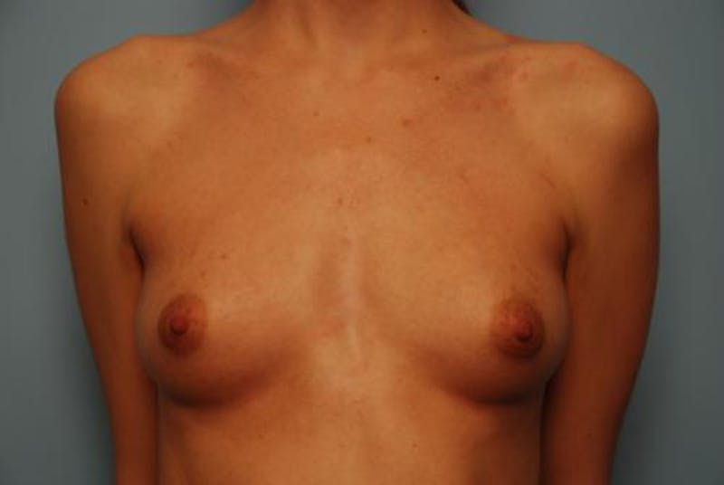 Breast Augmentation Before & After Gallery - Patient 404654 - Image 1