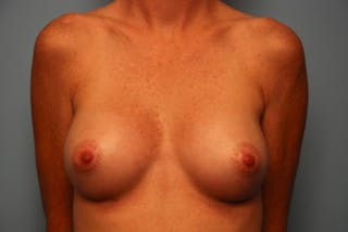 Breast Augmentation Before & After Gallery - Patient 242745 - Image 2