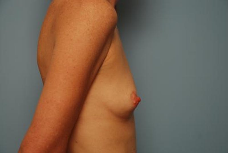 Breast Augmentation Before & After Gallery - Patient 242745 - Image 5