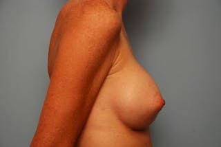 Breast Augmentation Before & After Gallery - Patient 242745 - Image 6