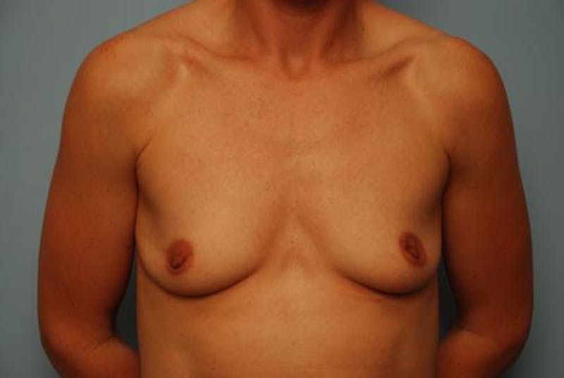 Breast Augmentation Before & After Gallery - Patient 113052 - Image 1