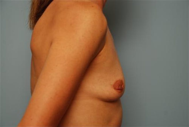 Breast Augmentation Before & After Gallery - Patient 113052 - Image 5
