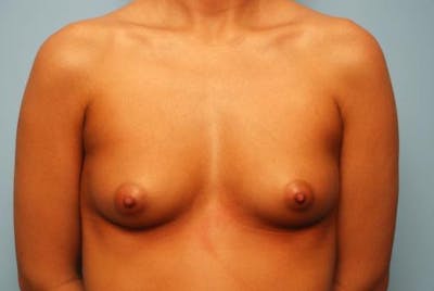 Breast Augmentation Before & After Gallery - Patient 186670 - Image 1