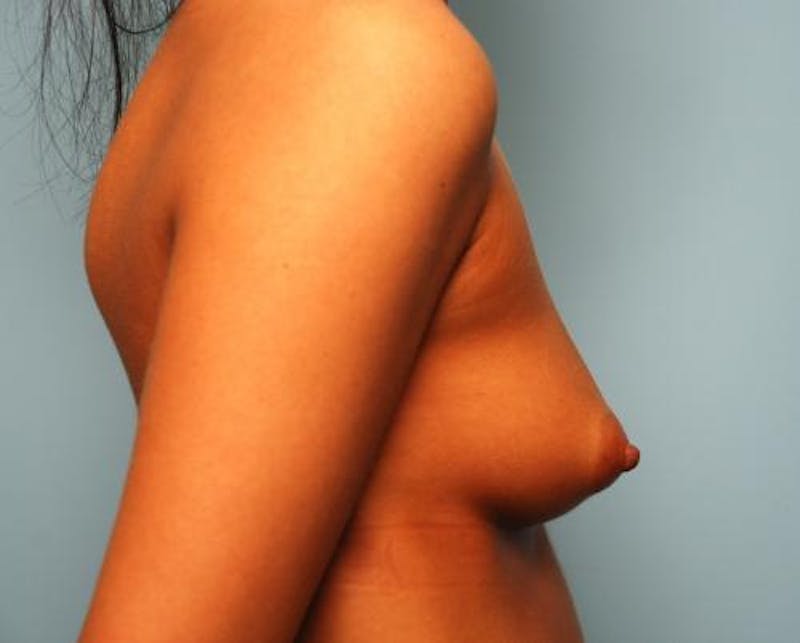 Breast Augmentation Before & After Gallery - Patient 186670 - Image 5