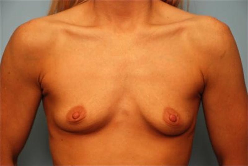 Breast Augmentation Before & After Gallery - Patient 145557 - Image 1