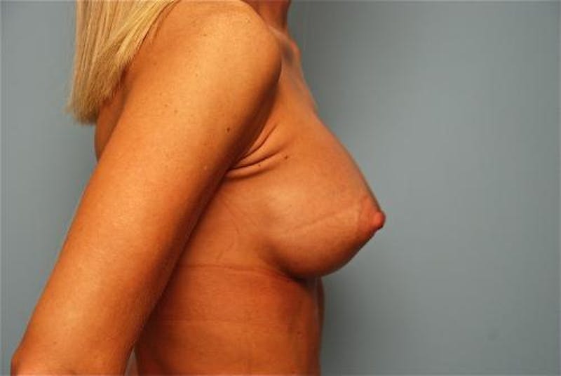 Breast Augmentation Before & After Gallery - Patient 145557 - Image 6