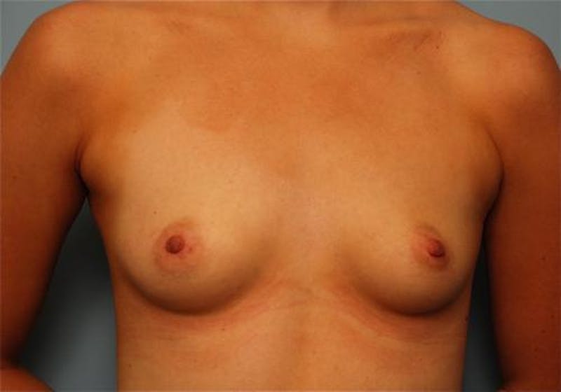 Breast Augmentation Before & After Gallery - Patient 948913 - Image 1