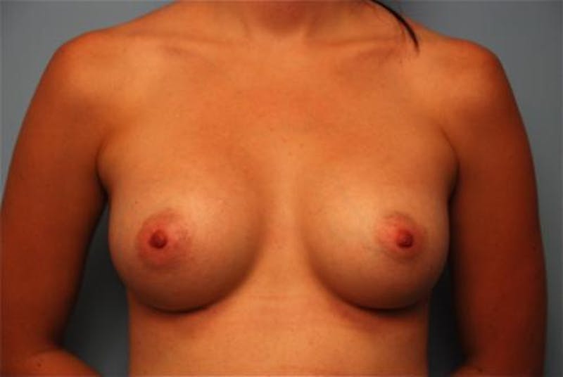 Breast Augmentation Before & After Gallery - Patient 948913 - Image 2