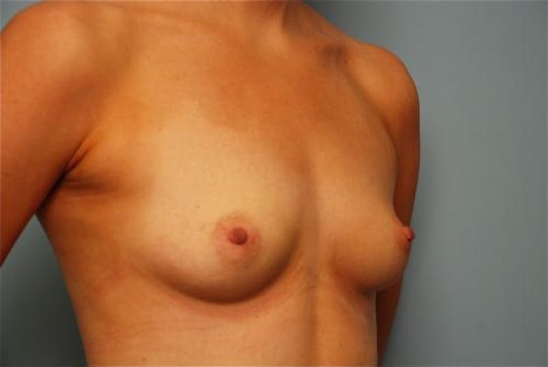 Breast Augmentation Before & After Gallery - Patient 948913 - Image 3