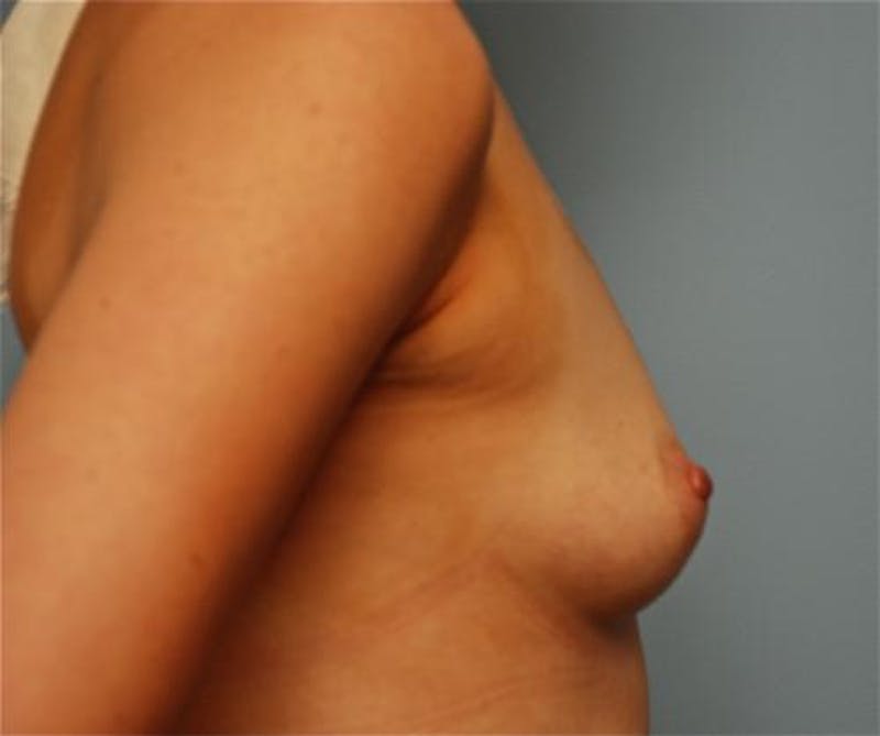 Breast Augmentation Before & After Gallery - Patient 948913 - Image 5