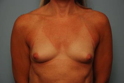 Breast Augmentation Before & After Gallery - Patient 327746 - Image 1