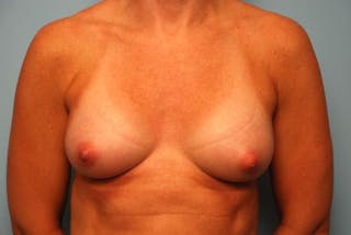 Breast Augmentation Before & After Gallery - Patient 327746 - Image 2