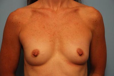 Breast Augmentation Before & After Gallery - Patient 291542 - Image 1