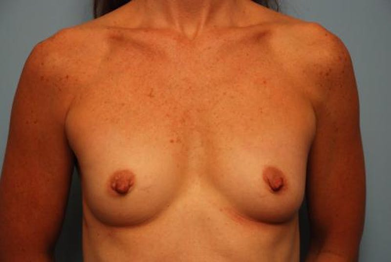 Breast Augmentation Before & After Gallery - Patient 291542 - Image 1