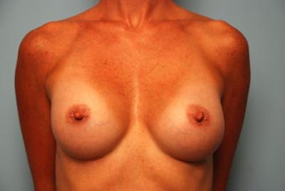 Breast Augmentation Before & After Gallery - Patient 291542 - Image 2