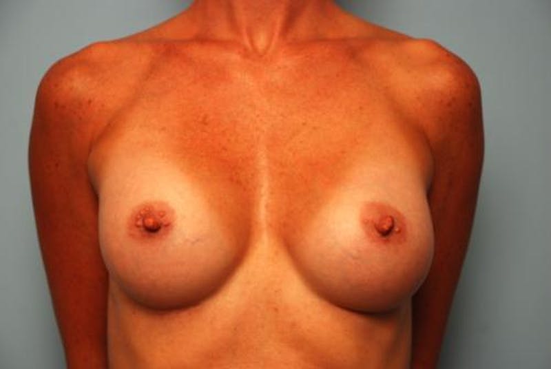 Breast Augmentation Before & After Gallery - Patient 291542 - Image 2