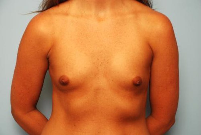 Breast Augmentation Before & After Gallery - Patient 173895 - Image 1