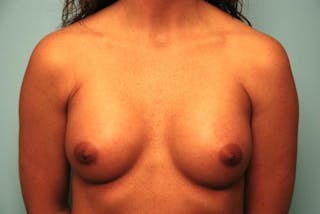 Breast Augmentation Before & After Gallery - Patient 173895 - Image 2