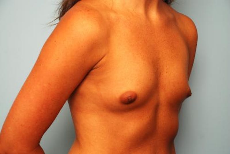 Breast Augmentation Before & After Gallery - Patient 173895 - Image 3