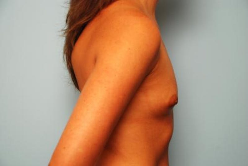 Breast Augmentation Before & After Gallery - Patient 173895 - Image 5