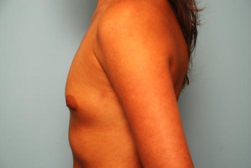 Breast Augmentation Before & After Gallery - Patient 173895 - Image 9