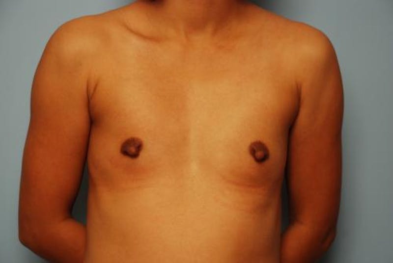 Breast Augmentation Before & After Gallery - Patient 313247 - Image 1