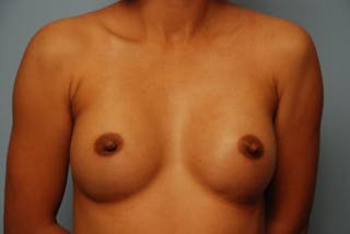 Breast Augmentation Before & After Gallery - Patient 313247 - Image 2