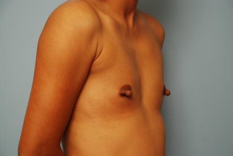 Breast Augmentation Before & After Gallery - Patient 313247 - Image 3