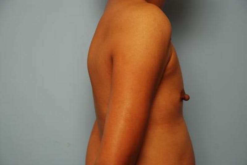 Breast Augmentation Before & After Gallery - Patient 313247 - Image 5