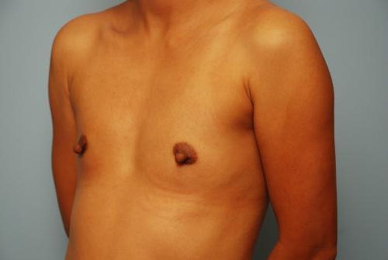 Breast Augmentation Before & After Gallery - Patient 313247 - Image 7
