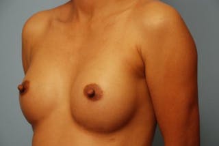 Breast Augmentation Before & After Gallery - Patient 313247 - Image 8