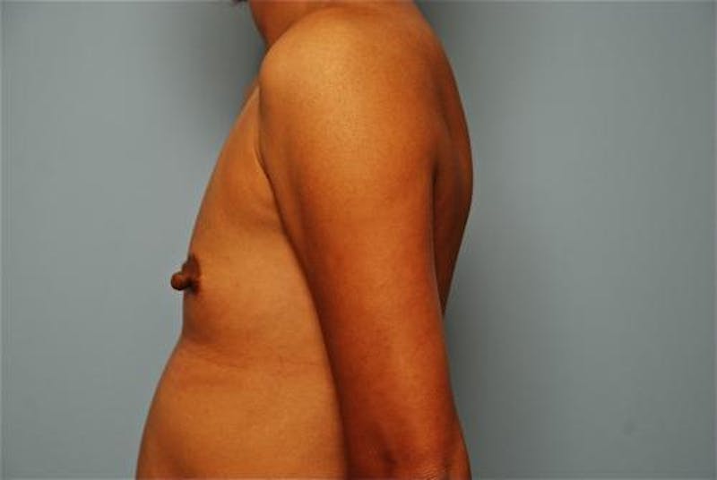 Breast Augmentation Before & After Gallery - Patient 313247 - Image 9