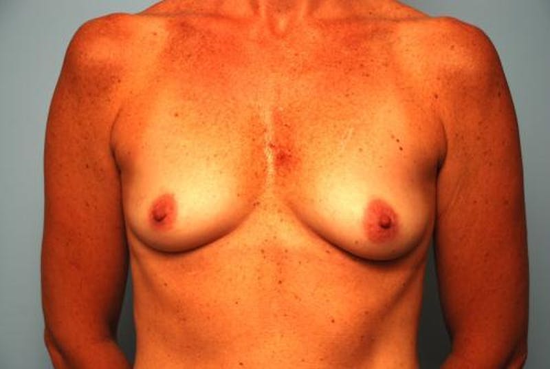 Breast Augmentation Before & After Gallery - Patient 248543 - Image 1