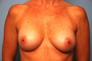 Breast Augmentation Before & After Gallery - Patient 248543 - Image 2