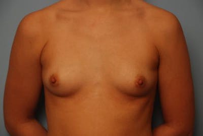 Breast Augmentation Before & After Gallery - Patient 391978 - Image 1