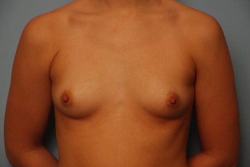 Breast Augmentation Before & After Gallery - Patient 391978 - Image 1