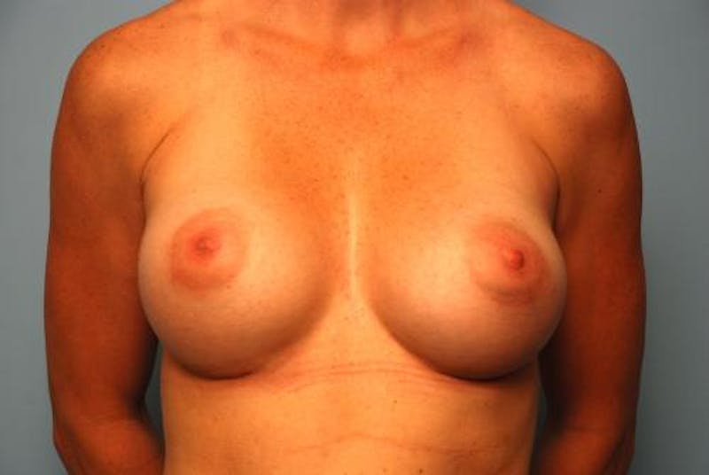 Breast Augmentation Before & After Gallery - Patient 307783 - Image 2