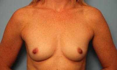 Breast Augmentation Before & After Gallery - Patient 998803 - Image 1