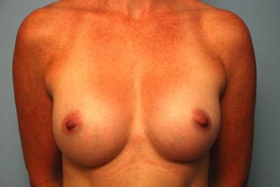Breast Augmentation Before & After Gallery - Patient 998803 - Image 2