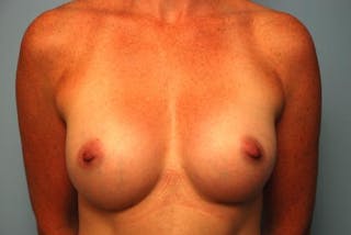 Breast Augmentation Before & After Gallery - Patient 998803 - Image 2